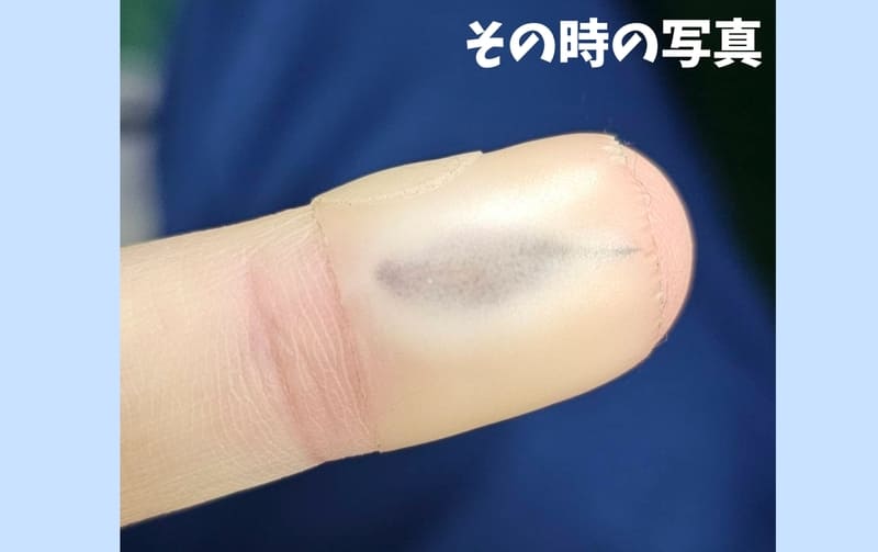 黒くなったキズパワーパッドの写真