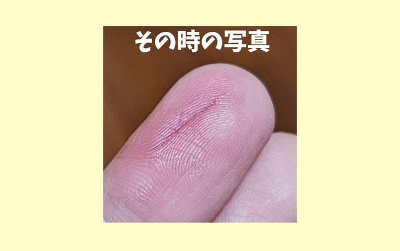 キズパワーパッドを剥がした時の写真